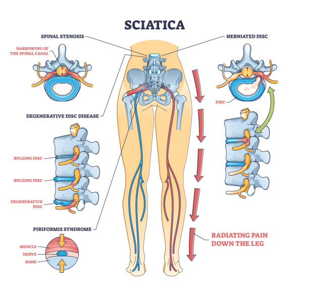 Understanding Sciatica